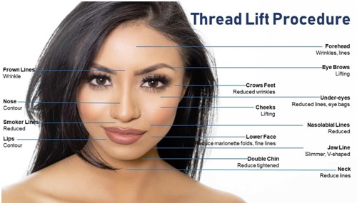 thread lift treatment in udaipur