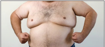 Gynecomastia Surgeon in udaipur