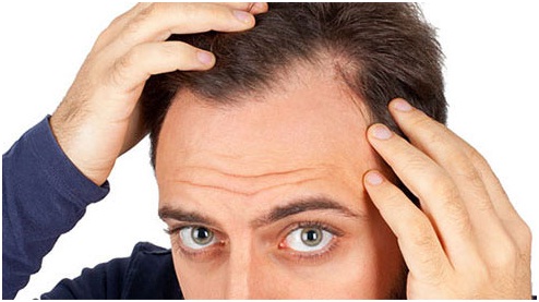 Best Hair Loss Treatment in Udaipur