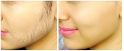 Laser Hair Removal in Udaipur