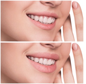 Lip Augmentation Surgery in Udaipur