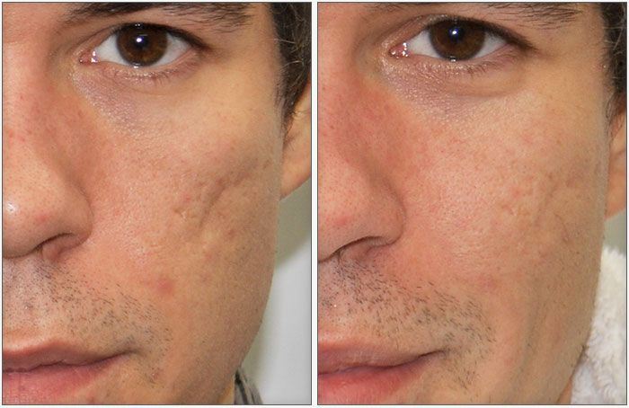 PRP Therapy For Face