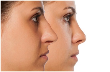 top rhinoplasty surgeons in Udaipur