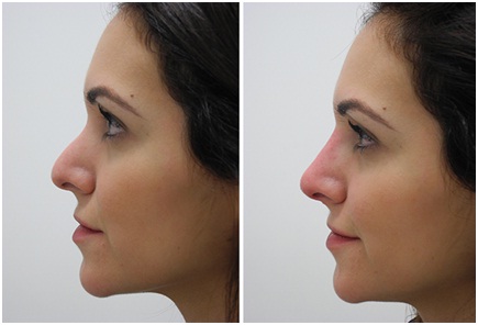 nose surgery straighten