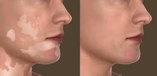 Best Cosmetic Surgeons in udaipur - Vitiligo Treatment